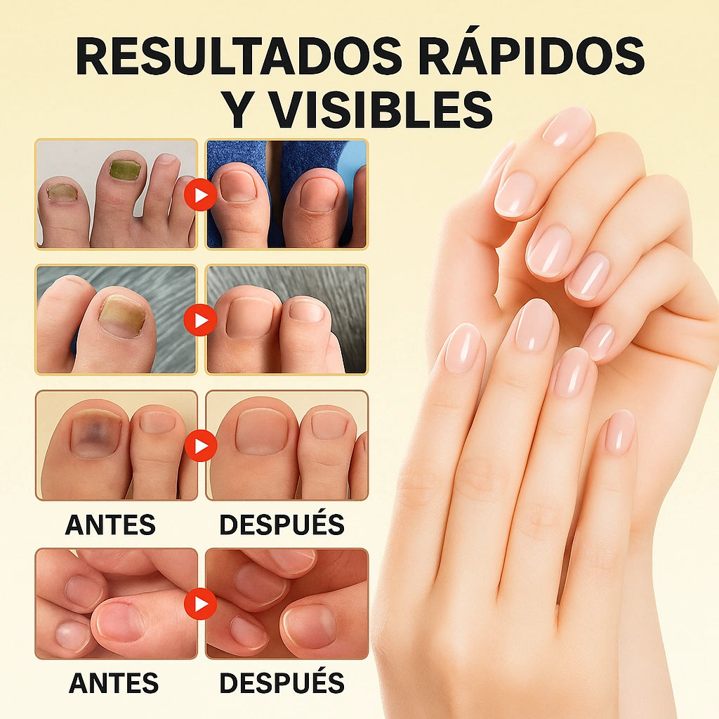 🦶 ¡OFERTA 2x1!  Tratamiento nocturno para el hongo de las uñas ¡Recupera su apariencia saludable!