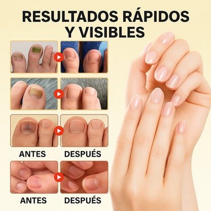 🦶 ¡OFERTA 2x1!  Tratamiento nocturno para el hongo de las uñas ¡Recupera su apariencia saludable!