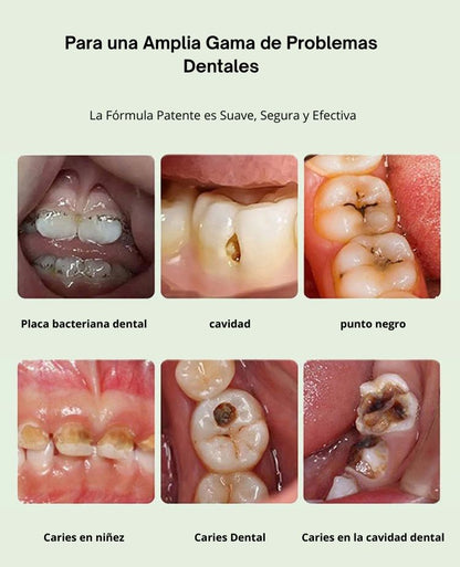 OFERTA 2X1 - Limpia Xtrem - Remueve hasta el 95% de manchas y caries